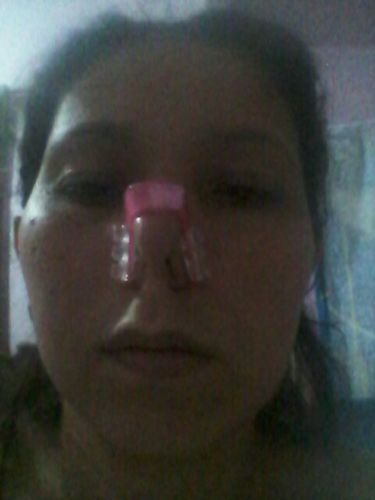 Customer photo review of Nose Shaper