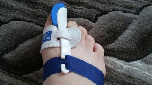 Customer photo review of Adjustable Orthopedic Bunion Corrector