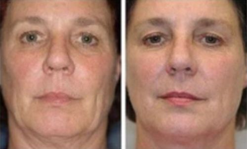 Customer photo review of Lumière Rouge ™