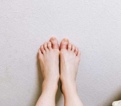 Customer photo review of BODYFEET ALIGNERS KIT