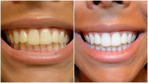 Customer photo review of Glory Smile™ - Bandes Blancheur
