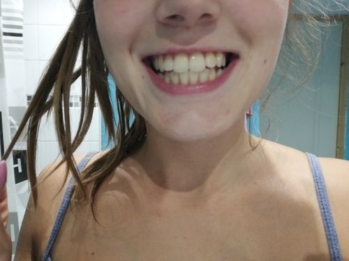 Customer photo review of Glory Smile™ - Bandes Blancheur