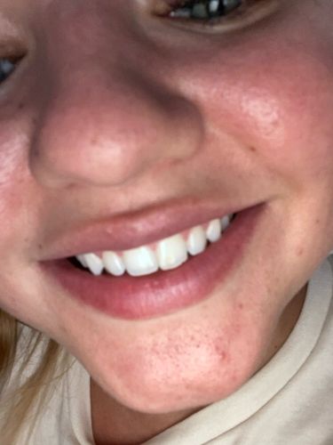 Customer photo review of Glory Smile™ - Bandes Blancheur