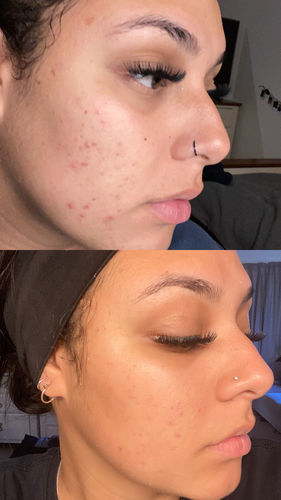 Customer photo review of Supercharged Skincare Bundle (TWIN PACK)