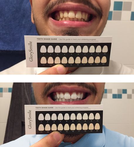 Customer photo review of Glory Smile™ - Bandes Blancheur 14 jours