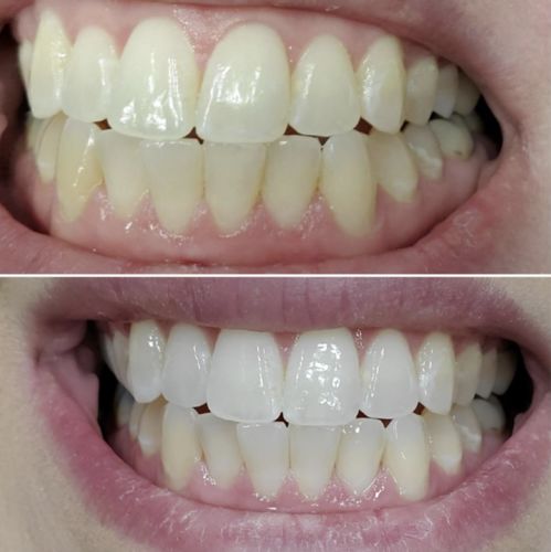 Customer photo review of NuTEETH™ Teeth Whitening Pen