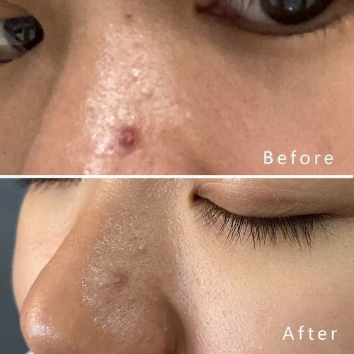 Customer photo review of CLEF Trial Package (Mask & Cleanser)