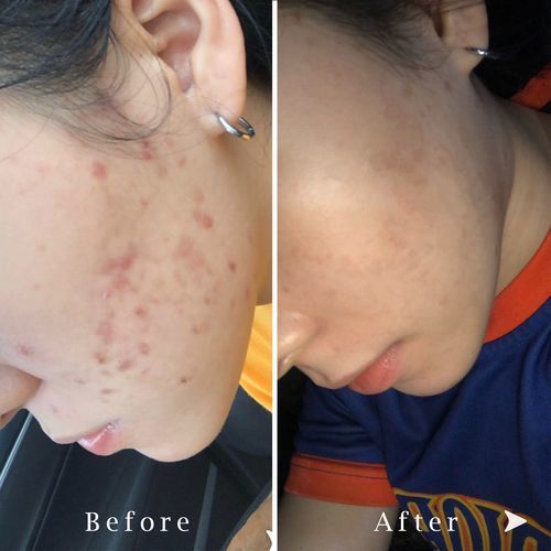 Customer photo review of Copper Peptide Mask