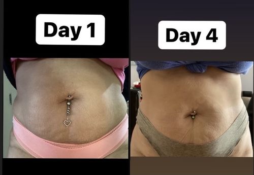 Customer photo review of 5 Day Tummy Tuck