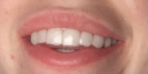 Customer photo review of SleepPro Retainers