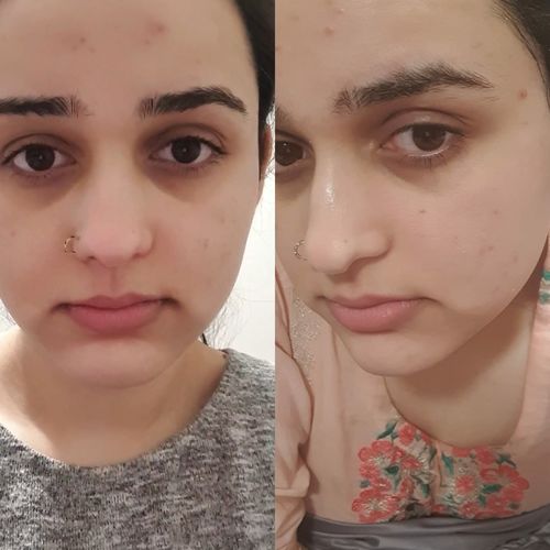 Customer photo review of Supercharged Skincare Bundle