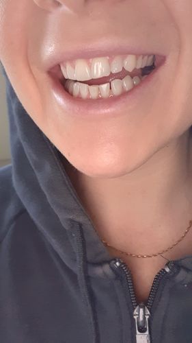 Customer photo review of Teeth Whitener