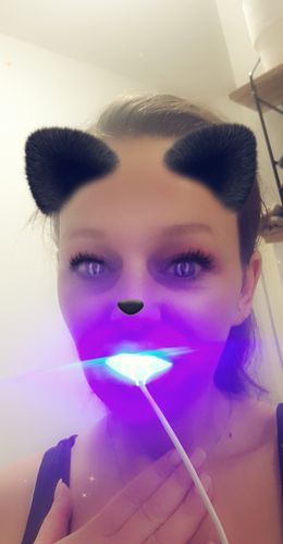 Customer photo review of PAP+ LED Teeth Whitening Kit