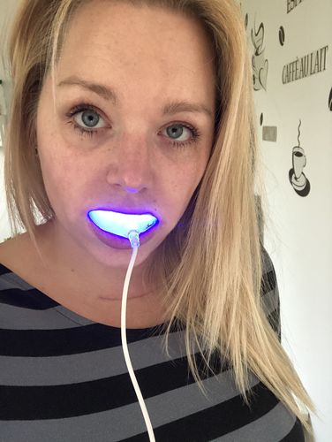 Customer photo review of PAP+ LED Teeth Whitening Kit