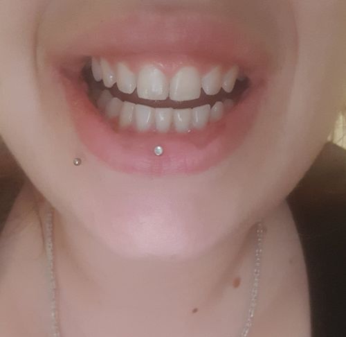 Customer photo review of PAP+ LED Teeth Whitening Kit