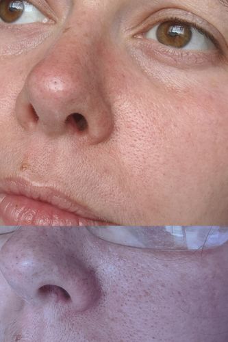 Customer photo review of SkinGlow Electric Cleanser - No More Blackheads