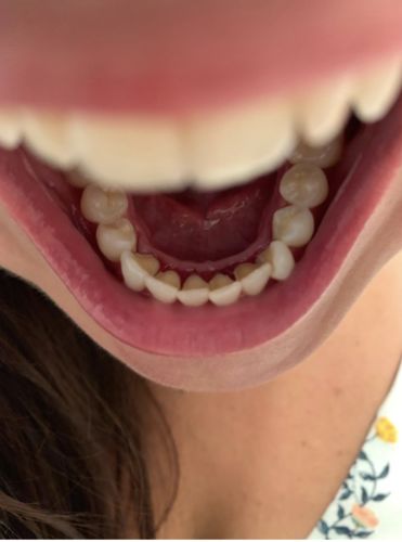 Customer photo review of NuTEETH™ Ultrasonic Tooth Cleaner