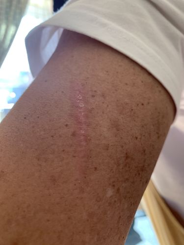 Customer photo review of Scar Minimising Oil