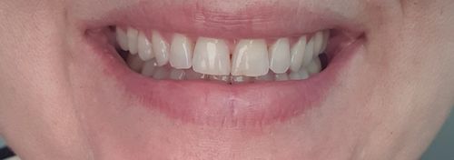 Customer photo review of SmileSecret Phonebleaching®
