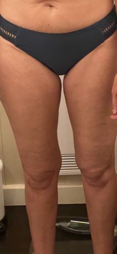 Customer photo review of Magnesium Therapy - Repair - Restore - Cellulite Reducing Bundle