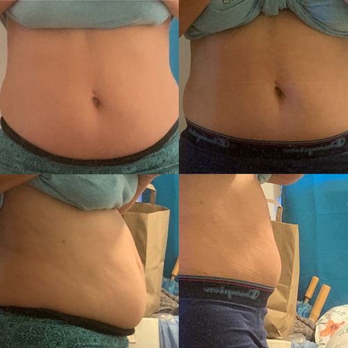 Customer photo review of 90 Uses Full Body with Renewal Serum, Awaken Serum and Cellulite Scrub