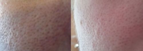 Customer photo review of High Five Skin™ Elektrisk ansiktsskrubbborste