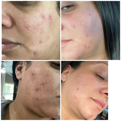 Customer photo review of (BOGO) AWAKEN: Skin Repair Intensive Healing Serum