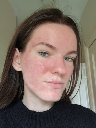 Customer photo review of SkinGlow Electric Cleanser - No More Blackheads