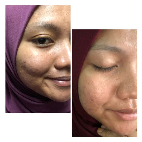 Customer photo review of Happiness box Edisi Kemerdekaan - Scar & Treatment set