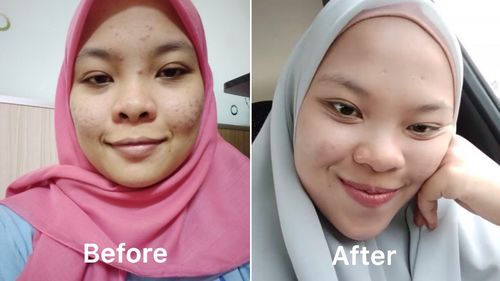 Customer photo review of Teamon Trial Kit