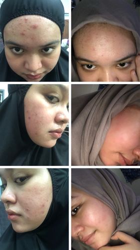 Customer photo review of Happiness box Edisi Kemerdekaan - Scar & Treatment set