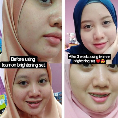 Customer photo review of Teamon brightening set