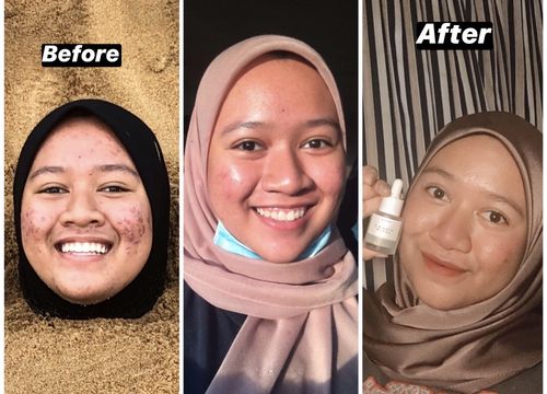 Customer photo review of Happiness box Edisi Kemerdekaan - Scar & Treatment set