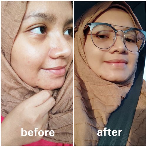 Customer photo review of Teamon treatment set
