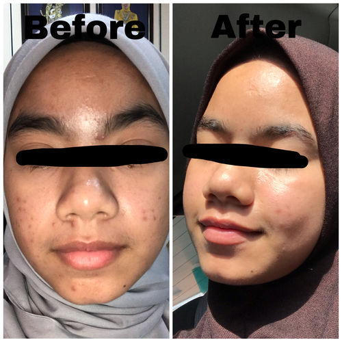 Customer photo review of Teamon treatment set