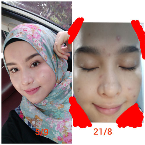 Customer photo review of Happiness box Edisi Kemerdekaan - Scar & Treatment set
