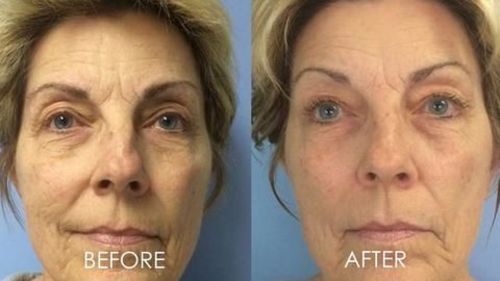 Customer photo review of Everything Beauty™ Professional LED Light Therapy