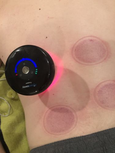 Customer photo review of Achedaway Cupper - The Smart Cupping Therapy Massager