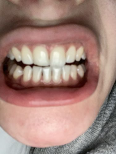 Customer photo review of GRATIS - 2x Refill Kit geschenkt