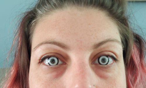 Customer photo review of PRIMAL® Rx Werewolf III - White Prescription Halloween contact Lenses