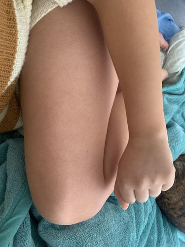 Customer photo review of WONDER SKIN HAIR REMOVAL ORGINAL CLASSIC PRO
