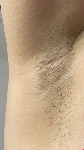 Customer photo review of WONDER SKIN HAIR REMOVAL ORGINAL CLASSIC PRO