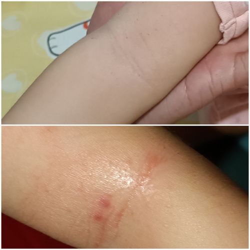 Customer photo review of Coco 清爽保濕套裝 (濕疹修護霜+蘆薈舒緩保濕凝膠)