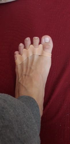 Customer photo review of Correcteur d'Hallux Valgus Confort+