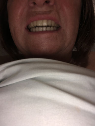 Customer photo review of SleepPro Slimline Night Guard 1.5mm