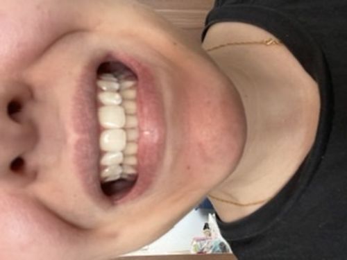 Customer photo review of PAP+ LED Teeth Whitening Kit