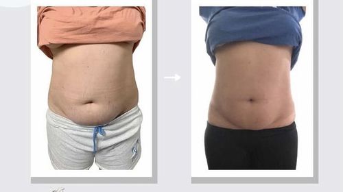 Customer photo review of Belly Treatment: Skin and Digestion 15 Day Magnesium Therapy Herbal Wrap