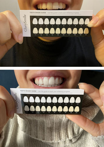 Customer photo review of Bandes Blanchissantes - Traitement 14 jours