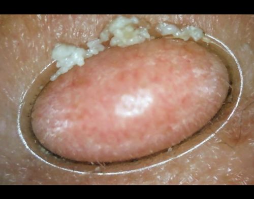 Customer photo review of Solvani Visible Pore Vacuum