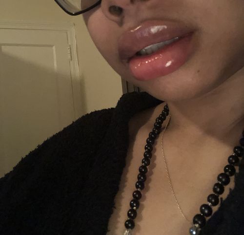 Customer photo review of LipFix: Filler